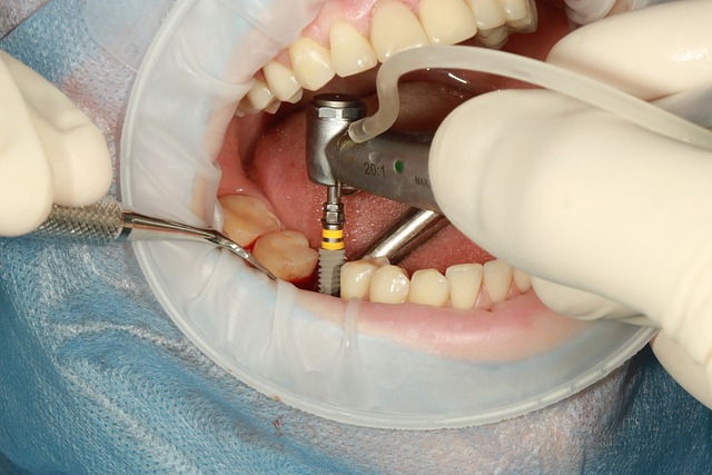 Dental Implants in Toms River, NJ | Dentistry Toms River